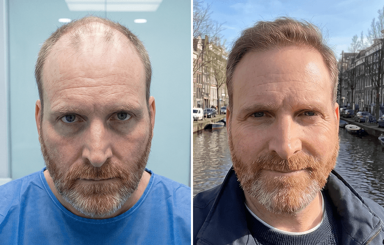 Hair Restoration